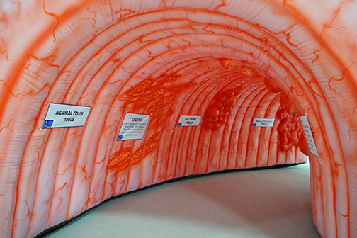 inflatable colon